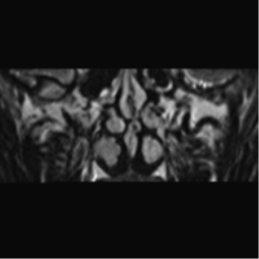 Cerebellopontine angle meningioma (Radiopaedia 48434-53348 Coronal T2 93).png