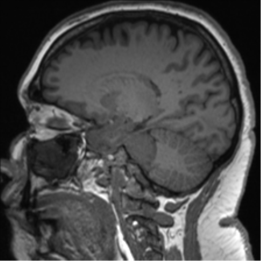 File:Cerebellopontine angle meningioma (Radiopaedia 48434-53348 Sagittal T1 38).png