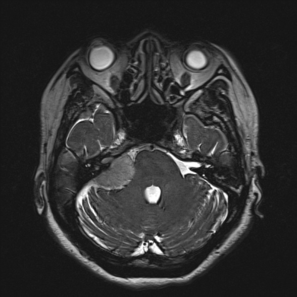 Cerebellopontine angle meningioma (Radiopaedia 53561-59591 Axial 3D volume T2 65).jpg