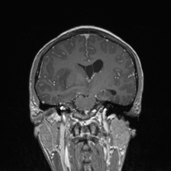 Cerebral abscess (Radiopaedia 24212-24478 Coronal T1 C+ 112).jpg