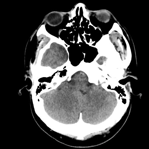File:Cerebral abscess (Radiopaedia 29451-29919 Axial non-contrast 11).jpg