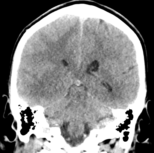 Cerebral abscess (Radiopaedia 60342-68008 Coronal non-contrast 40).png