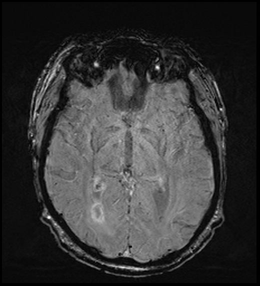 Cerebral abscess with ventriculitis (Radiopaedia 78965-91878 Axial SWI 27).jpg