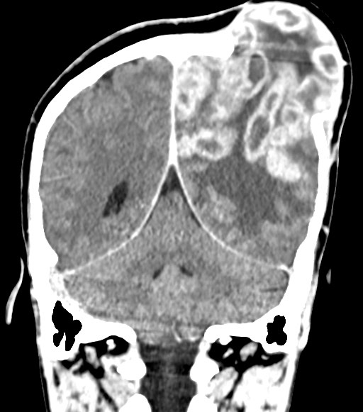 File:Cerebral abscesses (Radiopaedia 70458-80568 Coronal Contrast 47).jpg