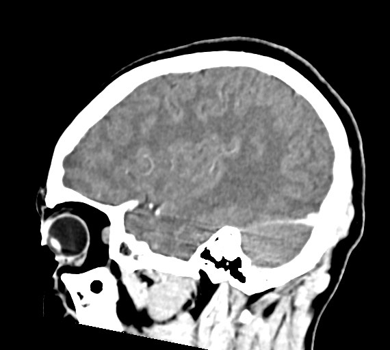 Cerebral abscesses (Radiopaedia 70458-80568 Sagittal Contrast 41).jpg