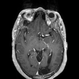 Cerebral amyloid angiopathy (Radiopaedia 29129-29518 Axial T1 C+ 67).jpg