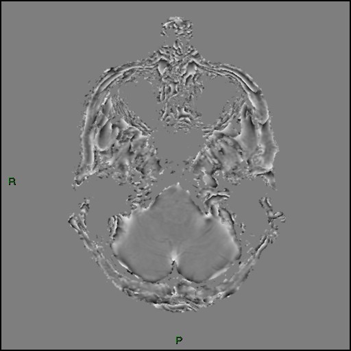 Cerebral amyloid angiopathy (Radiopaedia 77506-89664 H 19).jpg