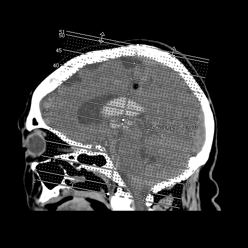 File:Cerebral aneurysm rupture (Radiopaedia 17508).jpg