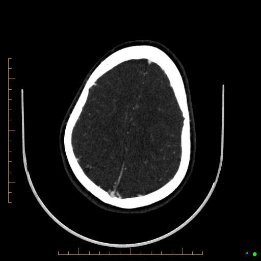 Cerebral arteriovenous malformation (AVM) (Radiopaedia 78162-90706 Axial CTA 216).jpg