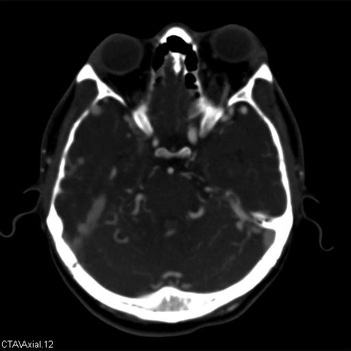 Cerebral arteriovenous malformation (Radiopaedia 28518-28759 B 12).jpg