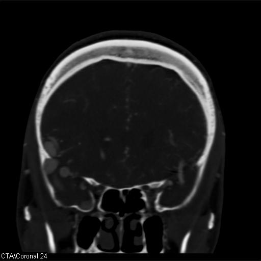 Cerebral arteriovenous malformation (Radiopaedia 28518-28759 C 24).jpg