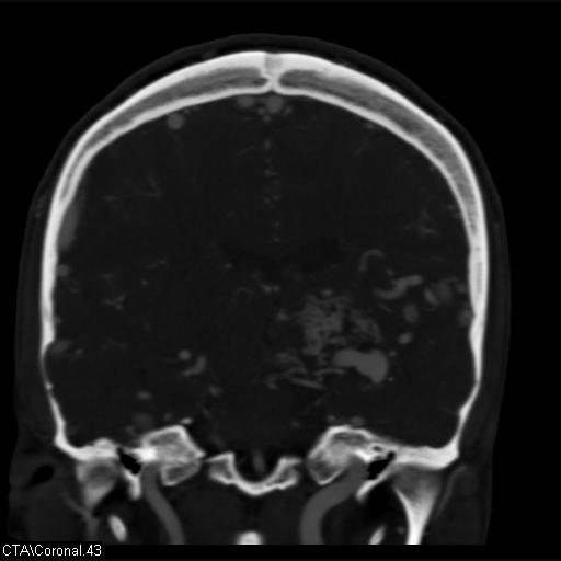 Cerebral arteriovenous malformation (Radiopaedia 28518-28759 C 43).jpg