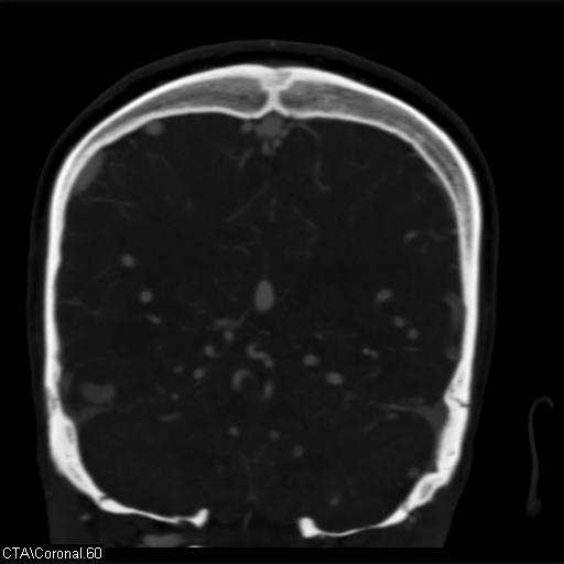 File:Cerebral arteriovenous malformation (Radiopaedia 28518-28759 C 60).jpg