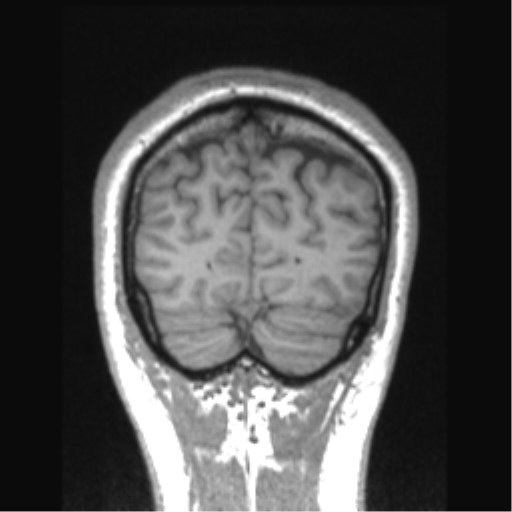 File:Cerebral arteriovenous malformation (Radiopaedia 39259-41506 Coronal T1 16).png