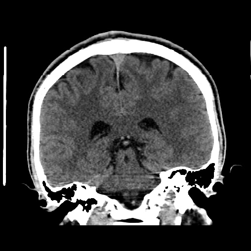 File:Cerebral arteriovenous malformation (Radiopaedia 61964-70028 Coronal non-contrast 38).jpg