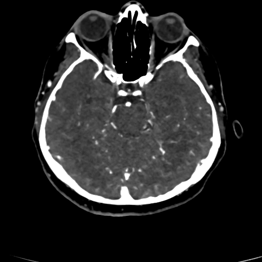 Cerebral arteriovenous malformation (Radiopaedia 73830-84645 Axial C+ delayed 61).jpg