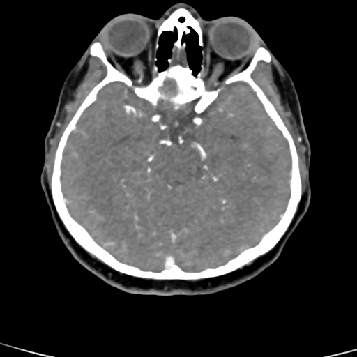 File:Cerebral arteriovenous malformation (Radiopaedia 73830-84645 B 63).jpg