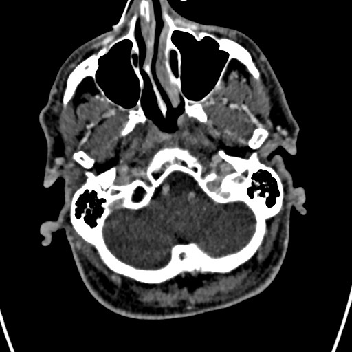 Cerebral arteriovenous malformation (Radiopaedia 78188-90746 Axial C+ delayed 23).jpg