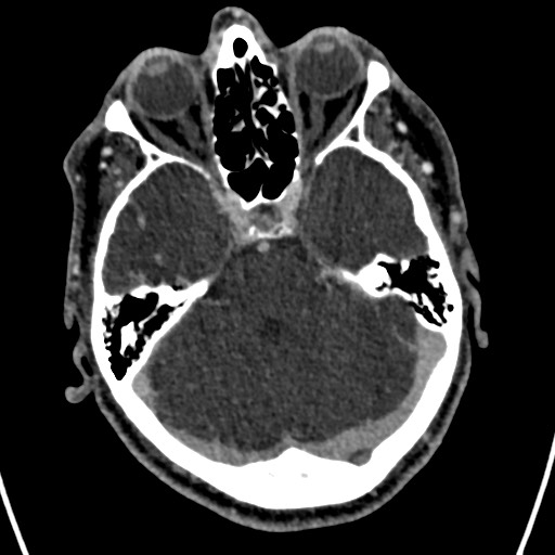Cerebral arteriovenous malformation (Radiopaedia 78188-90746 Axial C+ delayed 52).jpg