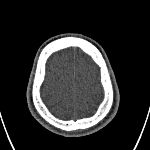 Cerebral arteriovenous malformation (Radiopaedia 78188-90746 Axial non-contrast 156).jpg