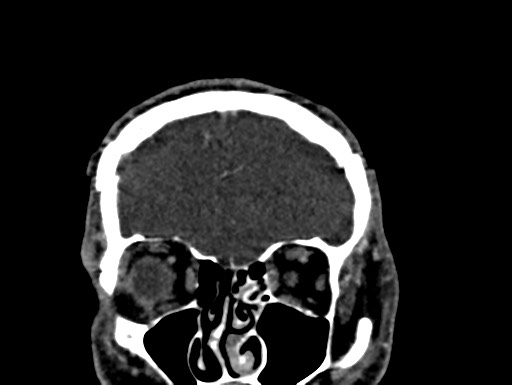 Cerebral arteriovenous malformation (Radiopaedia 78188-90746 Coronal C+ delayed 15).jpg