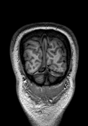 Cerebral arteriovenous malformation at posterior body of corpus callosum (Radiopaedia 74111-84925 Coronal T1 330).jpg
