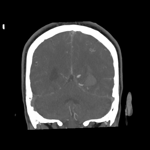 Cerebral arteriovenous malformation with lobar hemorrhage (Radiopaedia 35598-57216 C 68).jpg