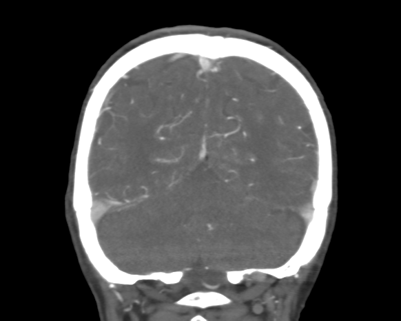 Cerebral arteriovenous malformation with lobar hemorrhage (Radiopaedia 44725-48511 A 45).png