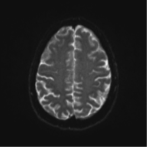 File:Cerebral cavernoma and development venous anomaly (Radiopaedia 37603-39482 Axial DWI 17).png