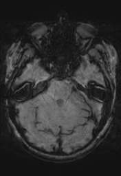 File:Cerebral cavernoma and development venous anomaly (Radiopaedia 37603-39482 Axial SWI 12).png