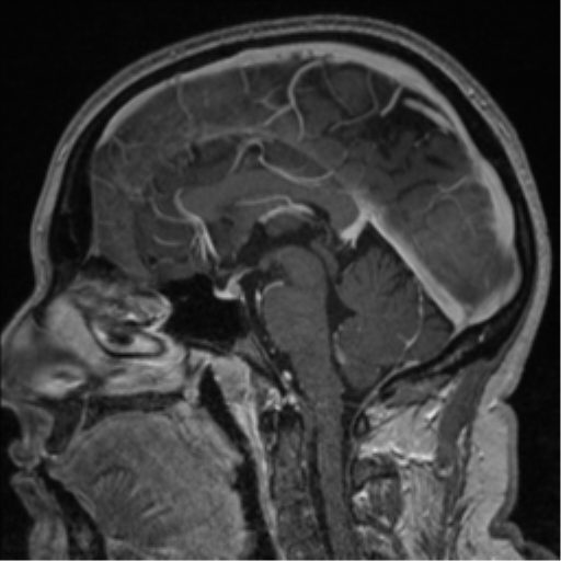 Cerebral cavernoma and development venous anomaly (Radiopaedia 37603-39482 Sagittal T1 C+ 49).png