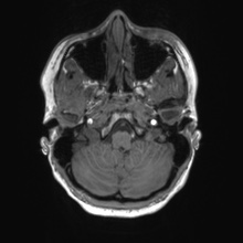 File:Cerebral cavernous venous malformation (Radiopaedia 70008-80021 Axial T1 10).jpg
