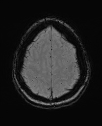 Cerebral cavernous venous malformation (Radiopaedia 70008-80021 I 62).jpg