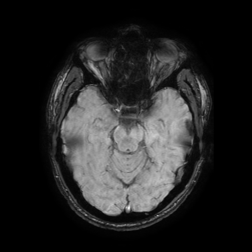 Cerebral cavernous venous malformation (Zabramski type II) (Radiopaedia 85511-101198 Axial SWI 51).jpg
