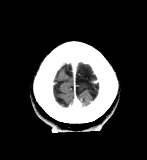 File:Cerebral cavernous venous malformations (Radiopaedia 48117-52945 Axial C+ delayed 31).png