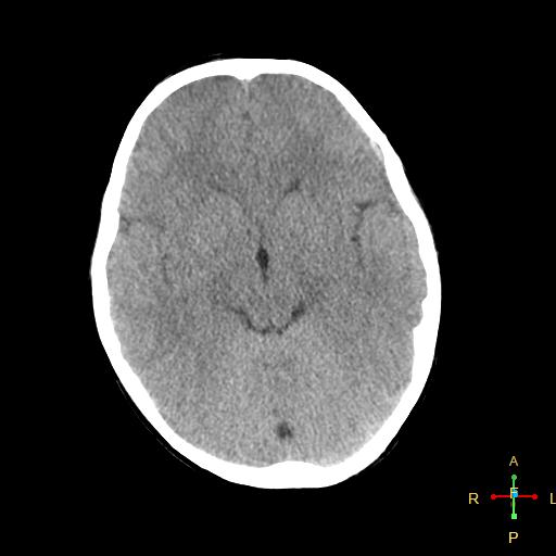 File:Cerebral contusion (Radiopaedia 48869-53911 Axial non-contrast 8).jpg