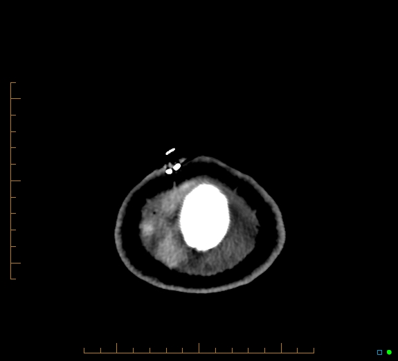 Cerebral fat embolism (Radiopaedia 85521-101224 Axial non-contrast 53).jpg