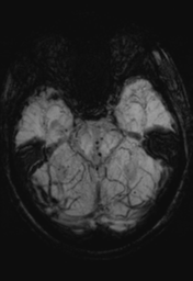 File:Cerebral hemorrhagic contusions- temporal evolution (Radiopaedia 40224-42757 Axial SWI 11).png