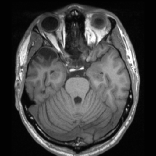 Cerebral hemorrhagic contusions- temporal evolution (Radiopaedia 40224-42757 Axial T1 26).png