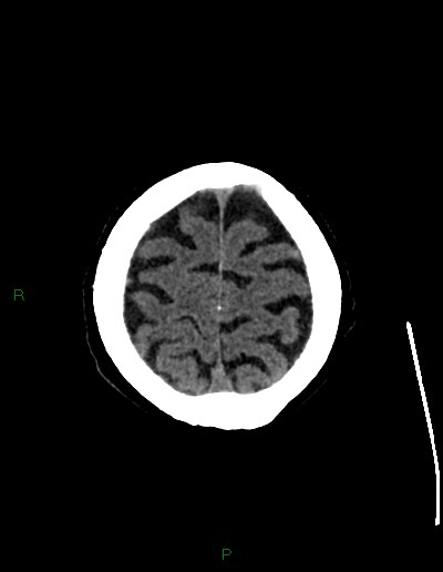 Cerebral metastases - ependymal and parenchymal (Radiopaedia 79877-93131 Axial non-contrast 70).jpg
