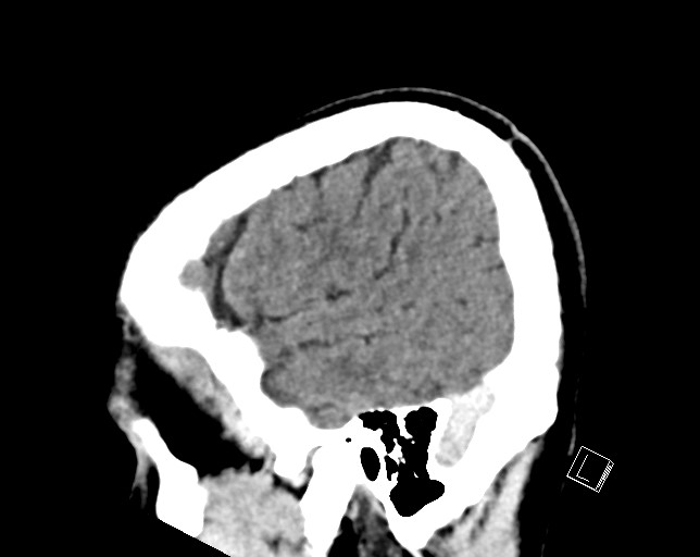 Cerebral metastases - testicular choriocarcinoma (Radiopaedia 84486-99855 F 48).jpg