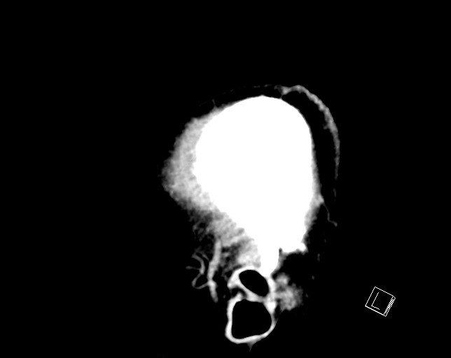 Cerebral metastases - testicular choriocarcinoma (Radiopaedia 84486-99855 F 7).jpg