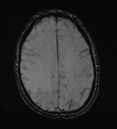 Cerebral metastasis - melanoma (Radiopaedia 54718-60954 Axial SWI 41).png