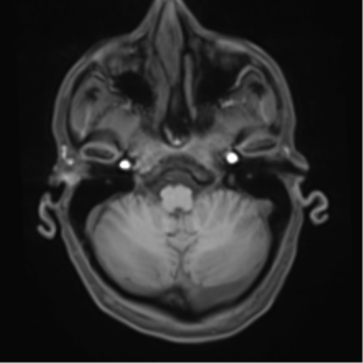 Cerebral metastasis - melanoma (Radiopaedia 54718-60954 Axial T1 12).png