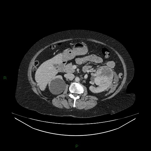 File:Cerebral metastasis from renal cell carcinoma (Radiopaedia 82306-96378 A 72).jpg