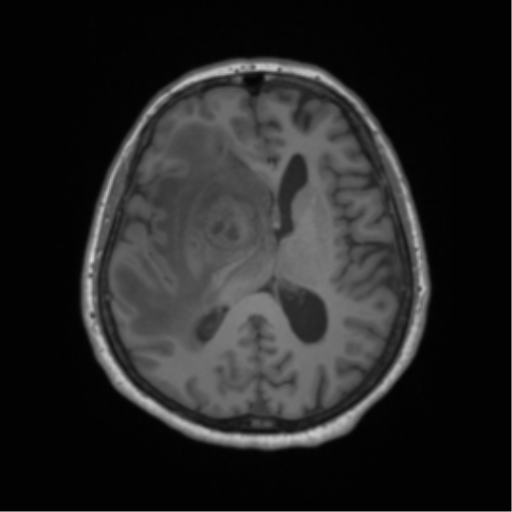 Cerebral metastasis to basal ganglia (Radiopaedia 81568-95413 Axial T1 40).png