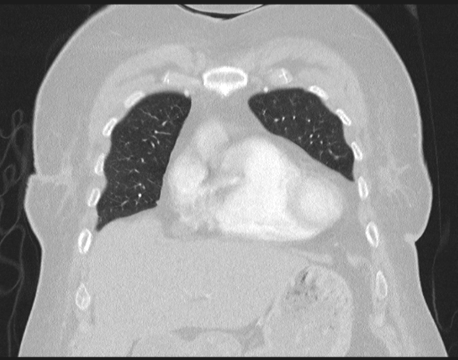 File:Cerebral metastasis to basal ganglia (Radiopaedia 81568-95414 Coronal lung window 24).png