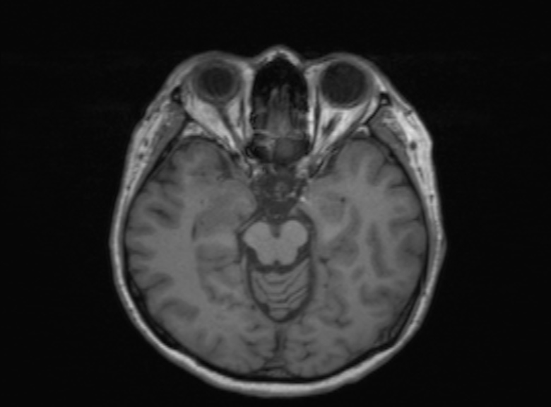Cerebral ring enhancing lesions - cerebral metastases (Radiopaedia 44922-48817 Axial T1 264).jpg