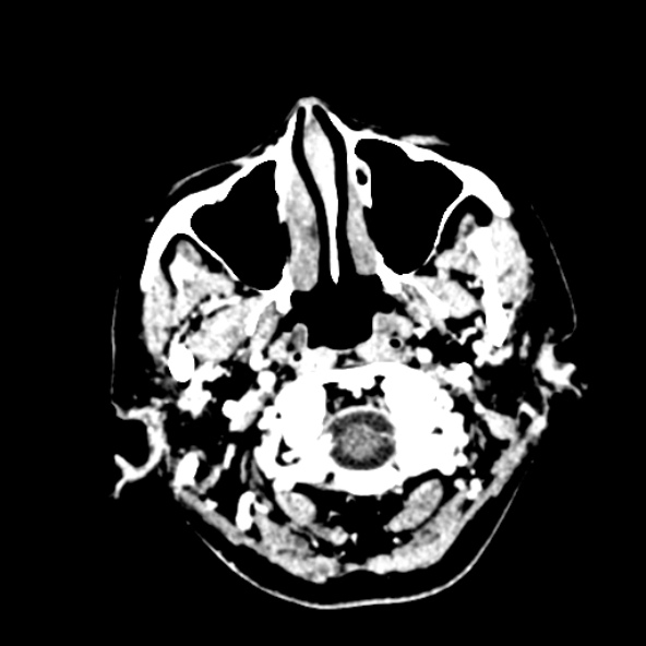 Cerebral ring enhancing lesions - cerebral metastases (Radiopaedia 44922-48818 B 18).jpg