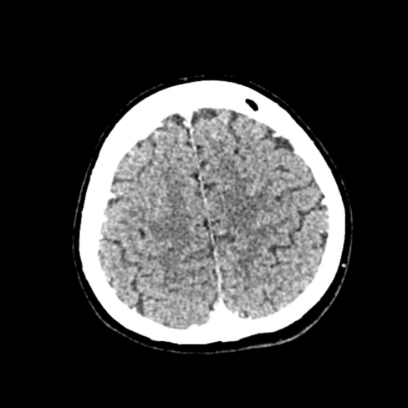 Cerebral ring enhancing lesions - cerebral metastases (Radiopaedia 44922-48818 B 228).jpg